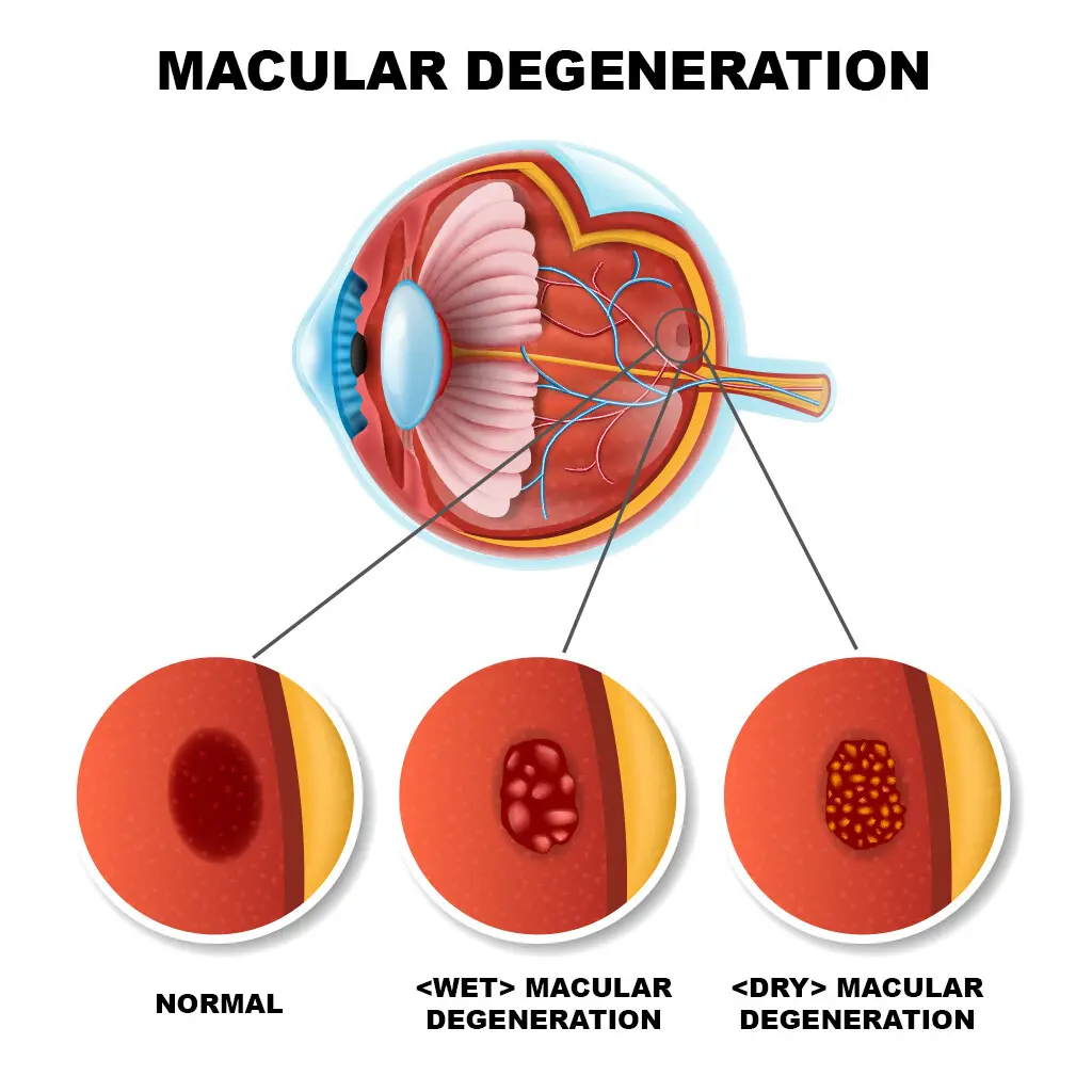 Thoái Hóa Điểm Vàng Do Tuổi Tác: Khi Ánh Nhìn Trung Tâm Trở Nên Xa Vời